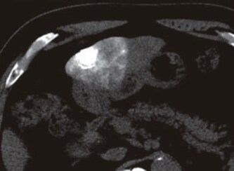 S3: Simple CT (l) immediately after TACE