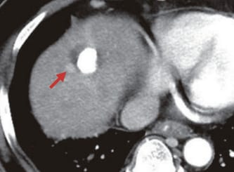 S8: Arterial phase of contrast CT (m)