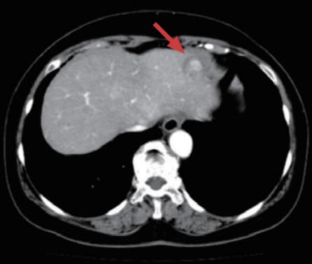 a) Arterial phase