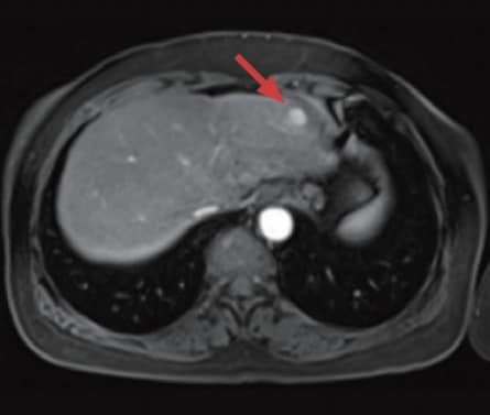 c) Arterial phase