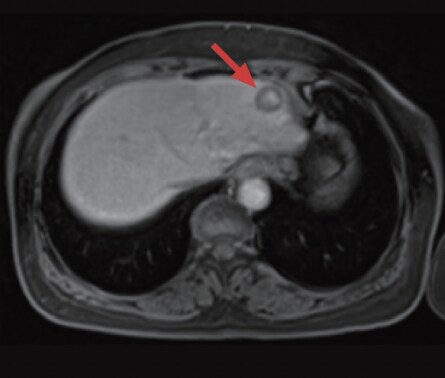 d) Hepatobiliary phase