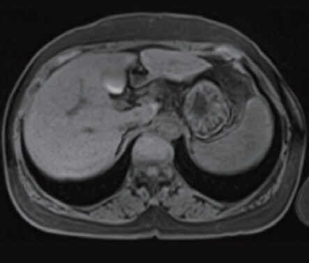 e) Pre-contrast, T1-weighted image