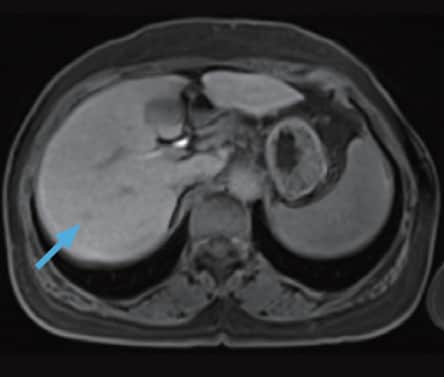 h) Hepatobiliary phase
