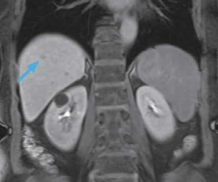 i) Hepatobiliary phase