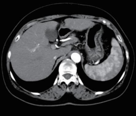 j) Early arterial phase