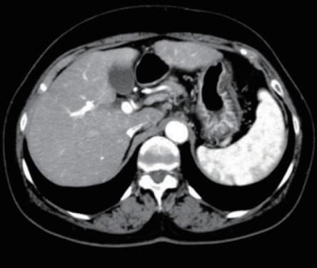 k) Late arterial phase
