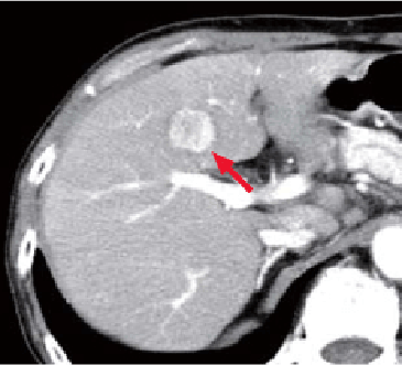 a) Arterial phase