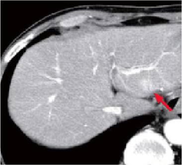 c) Arterial phase