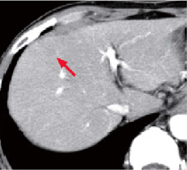 e) Arterial phase