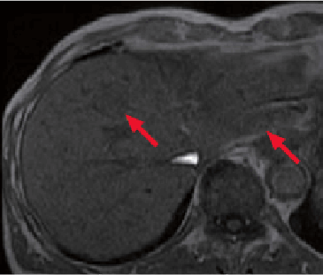 g) Pre-contrast, T1-weighted imaging, in phase