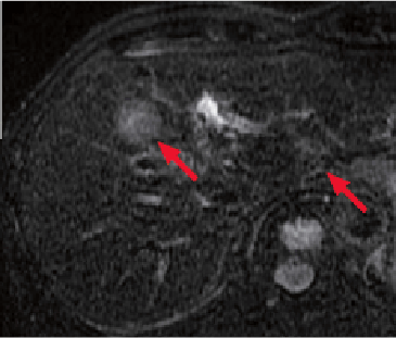 i) T2-weighted imaging