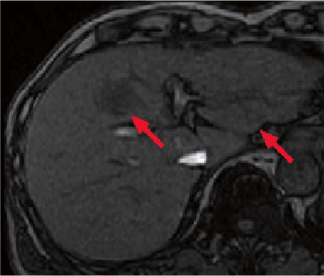 h) Pre-contrast, T1-weighted imaging, out of phase