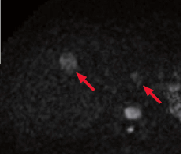 j) Diffusion-weighted imaging (b value = 1000 s/mm2)
