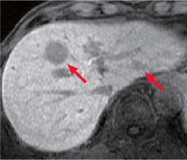 l) Hepatobiliary phase