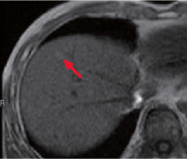 m) Pre-contrast, T1-weighted image, in phase