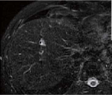 o) T2-weighted image