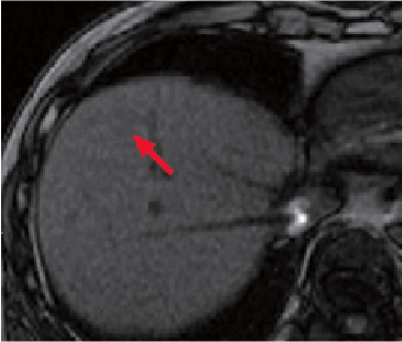 n) Pre-contrast, T1-weighted image, out of phase