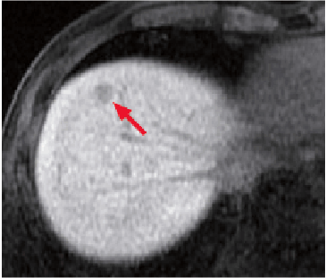 r) Hepatobiliary phase