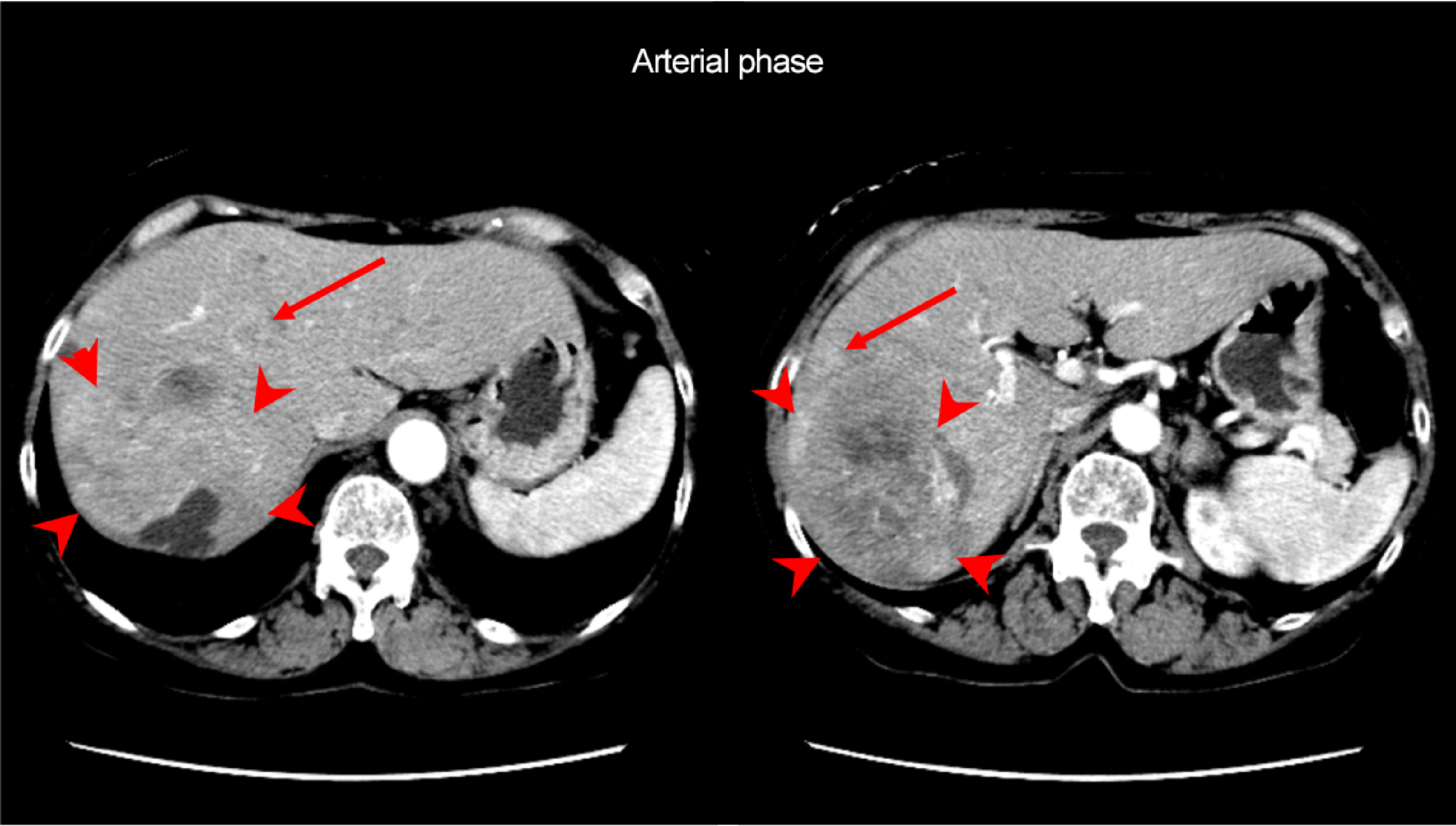 Fig. 1. Dynamic contrast CT arterial and equilibrium phases