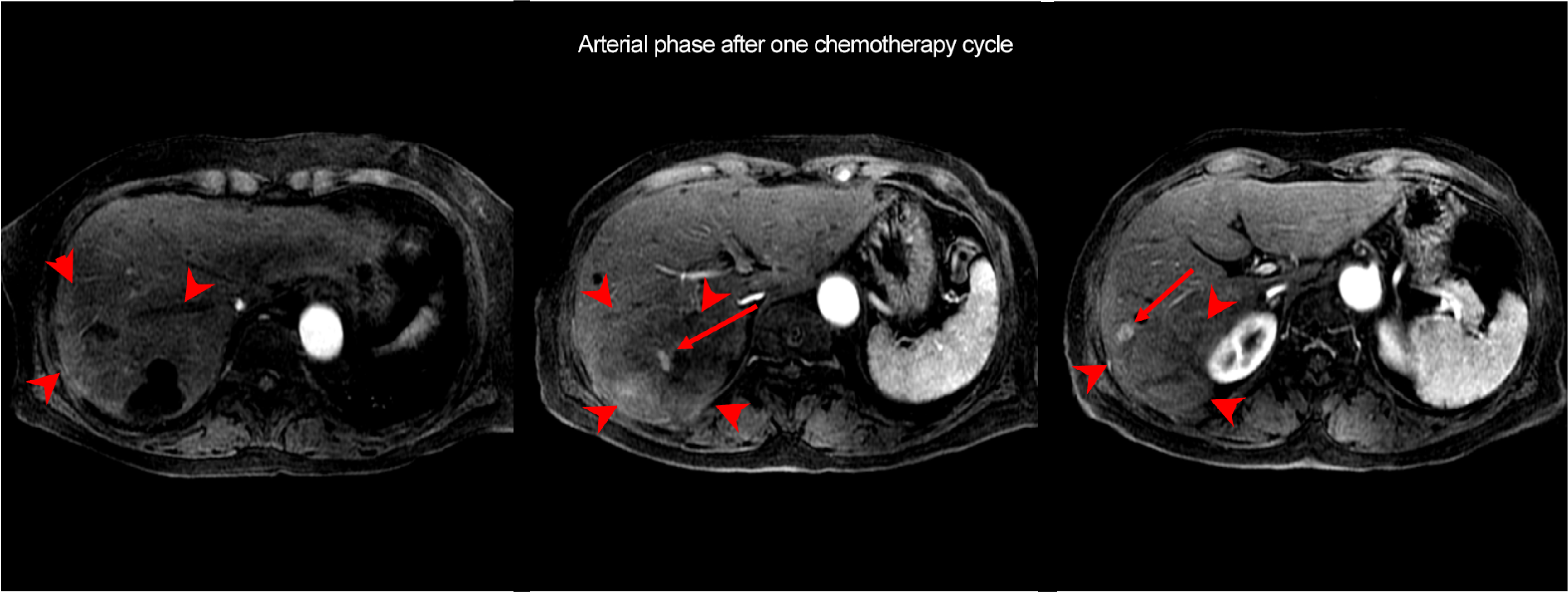 Fig. 2. EOB-MRI arterial and hepatobiliary phases after one chemotherapy cycle