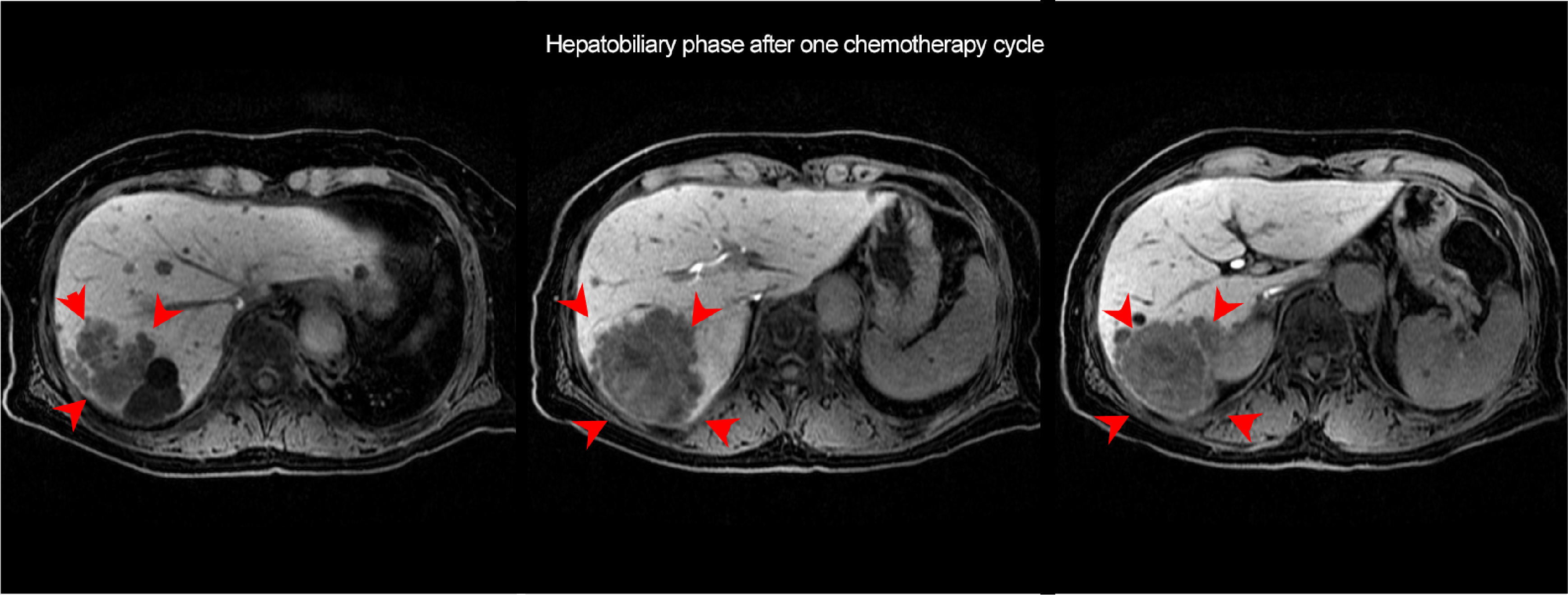 Fig. 2. EOB-MRI arterial and hepatobiliary phases after one chemotherapy cycle