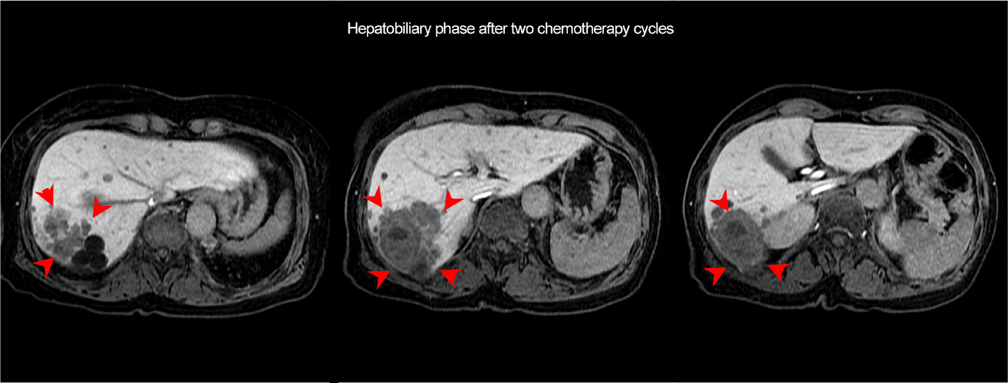 Fig. 3. EOB-MRI arterial and hepatobiliary phases after two chemotherapy cycles
