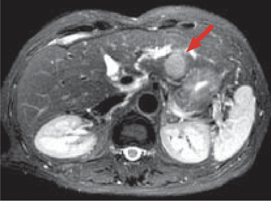 c) T2-weighted image