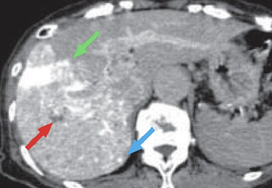 c) Computed tomography during hepatic arteriography (CTHA)