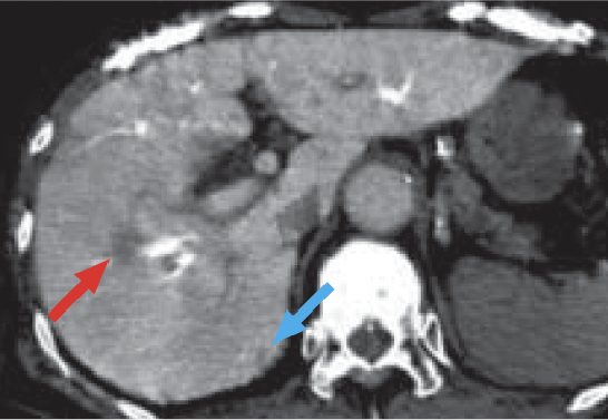 d) Computed tomography during arterial portography (CTAP)