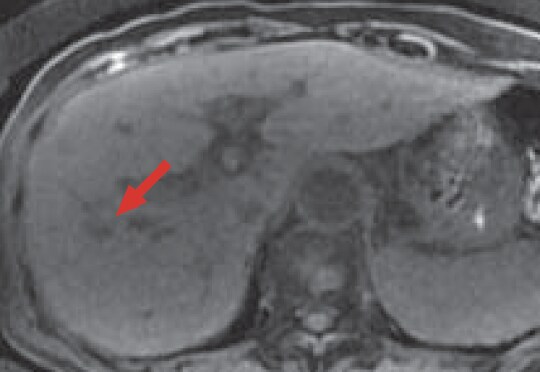 e) Pre-contrast, T1-weighted image