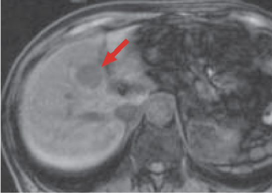 c) Pre-contrast, T1-weighted image