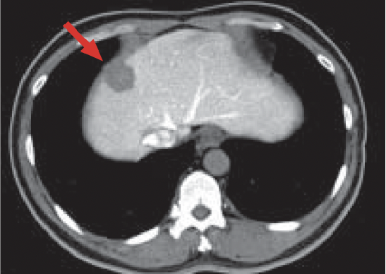 b) CT during arterial portography (CTAP)