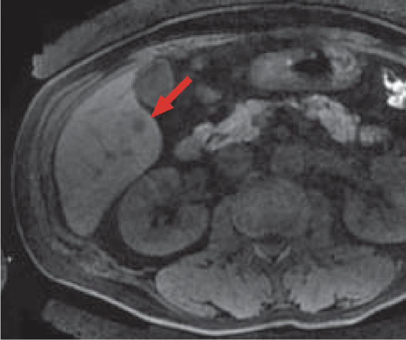 c) Pre-contrast, T1-weighted imaging