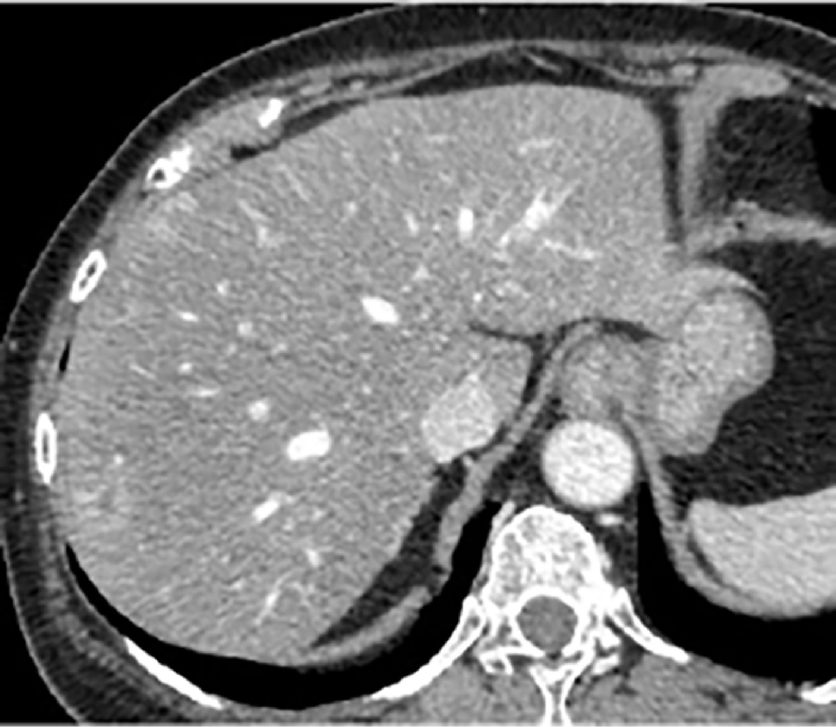 A nodule showing contrast enhancement was found in S7 of the liver left lobe.