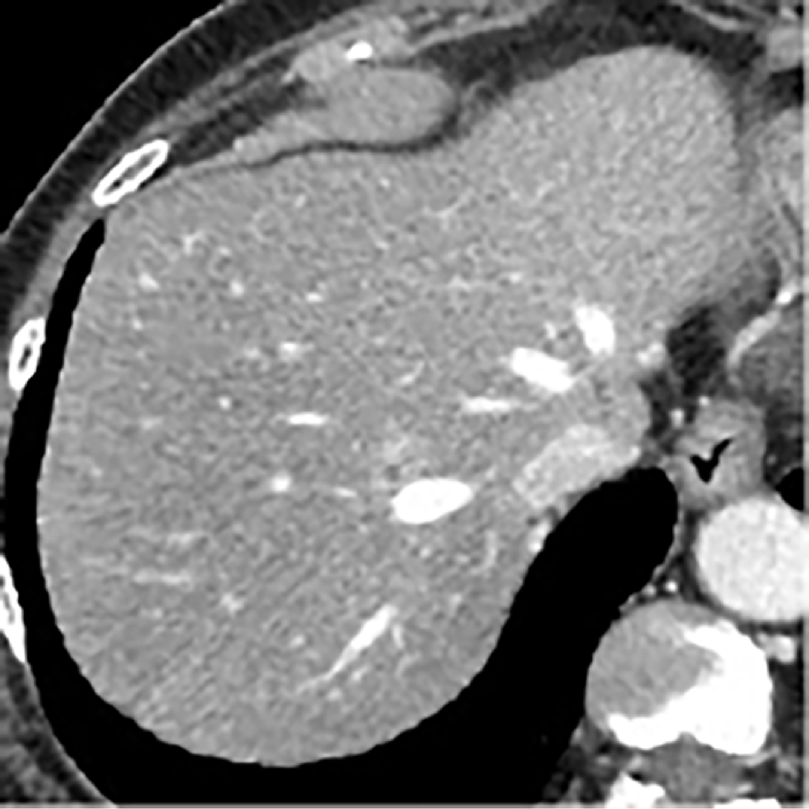 Fig. 2. Contrast CT in December of Year 202X