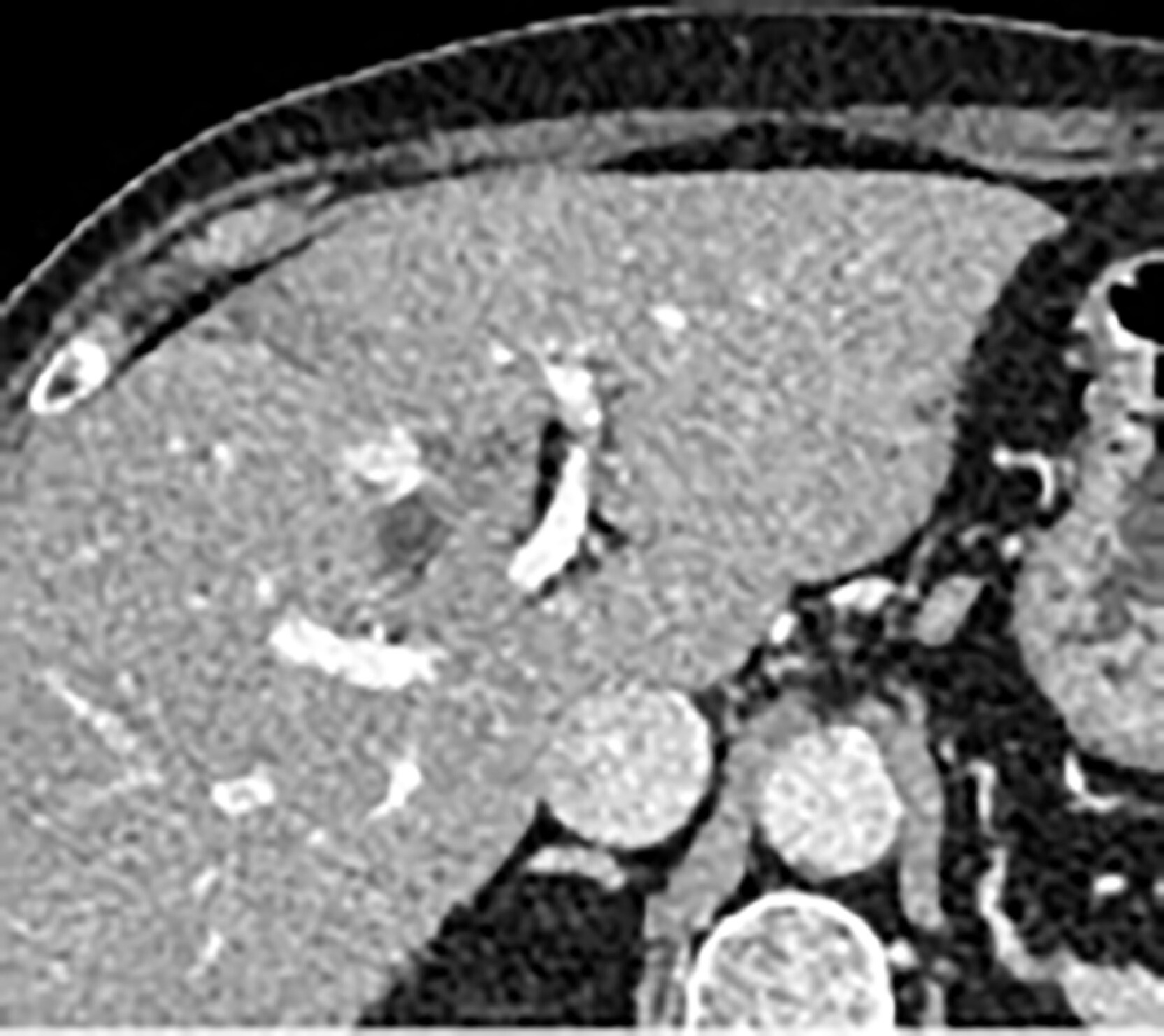 Fig. 3. Contrast CT in December of Year 202X