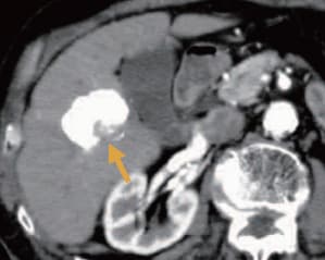 Arterial-dominant phase (f)