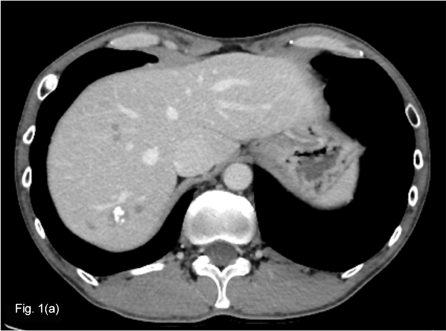 Fig. 1. Contrast CT equilibrium phase