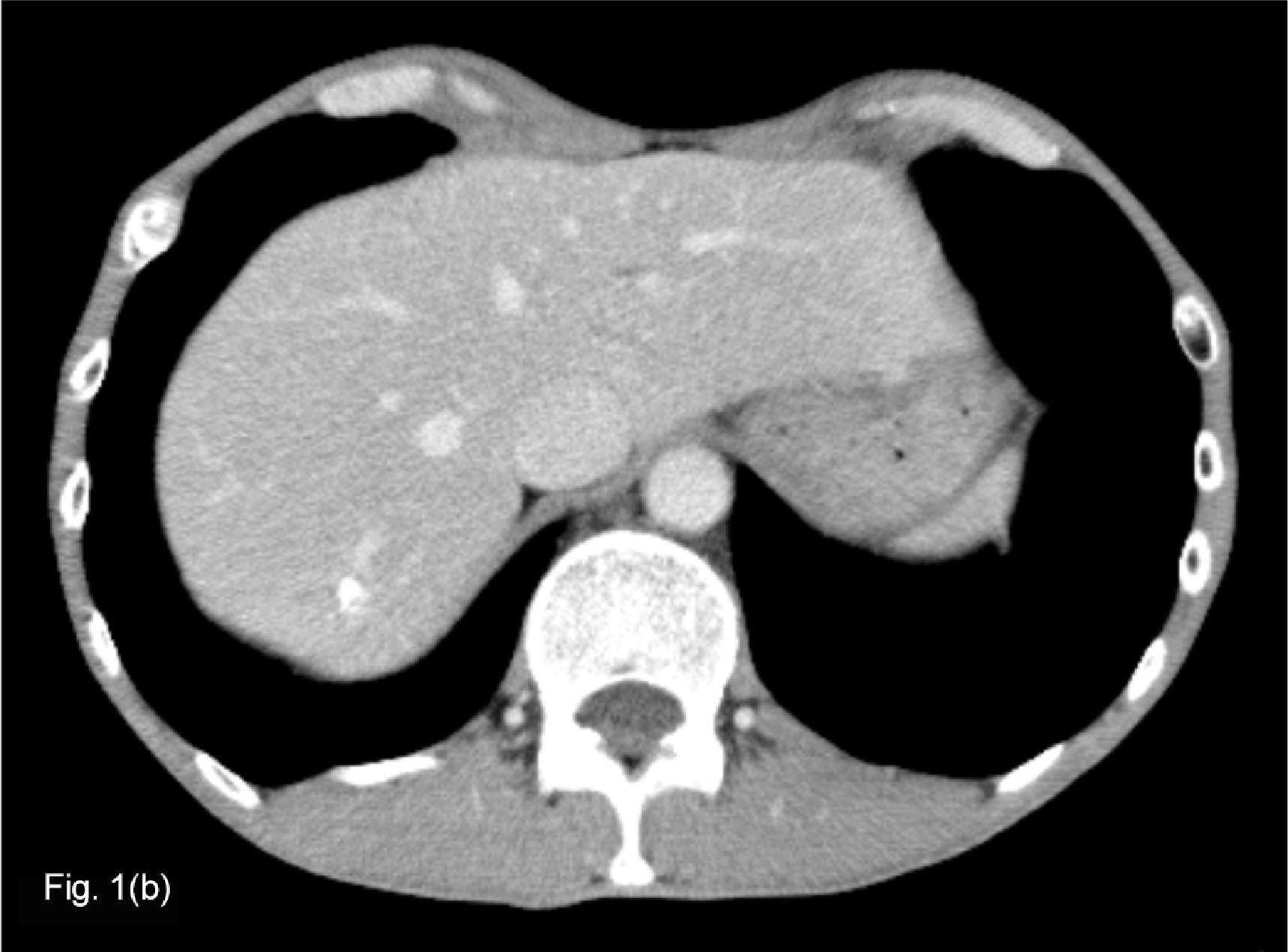 Fig. 1. Contrast CT equilibrium phase