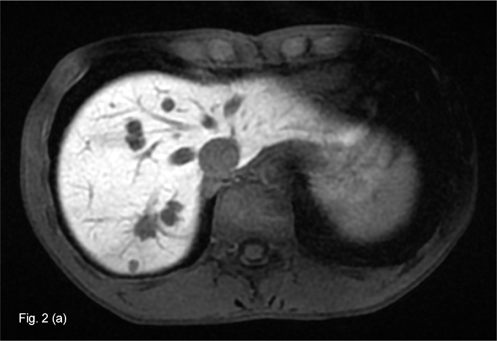 Fig. 2. EOB-MRI hepatobiliary phase