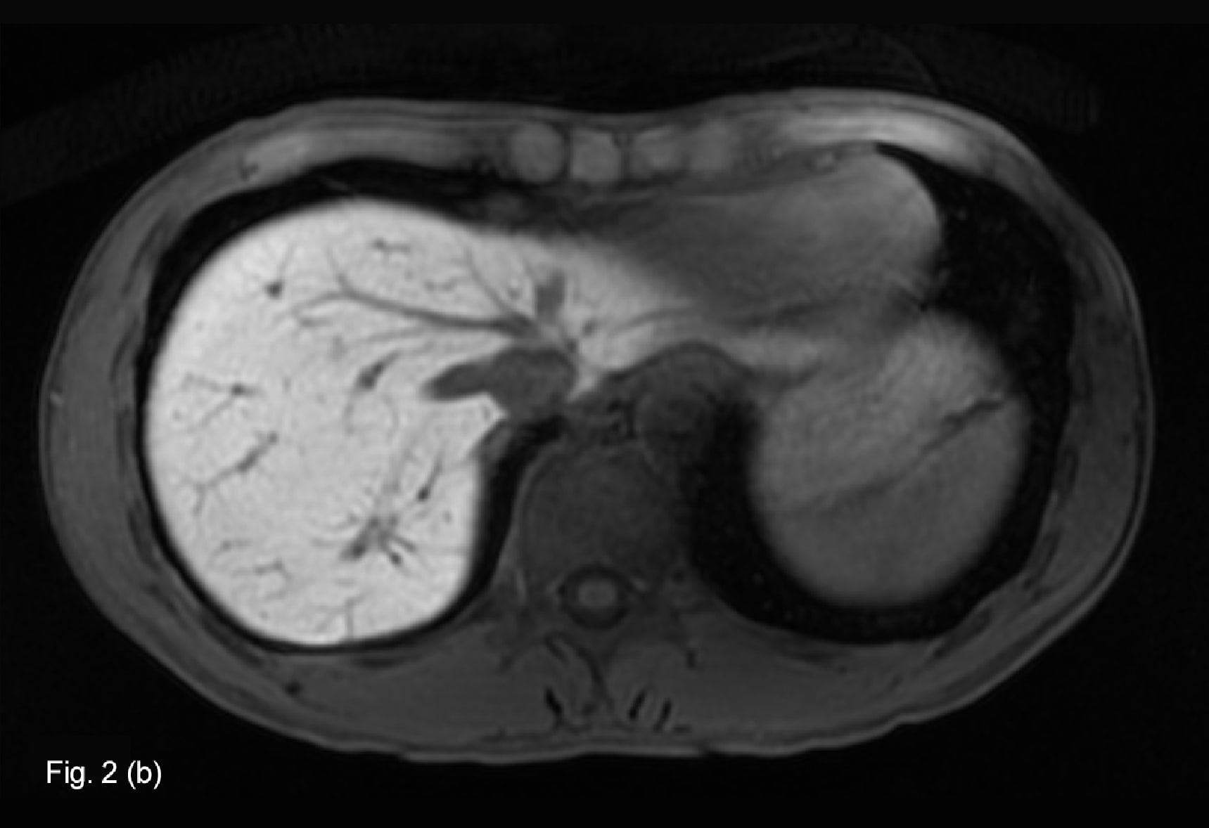 Fig. 2. EOB-MRI hepatobiliary phase