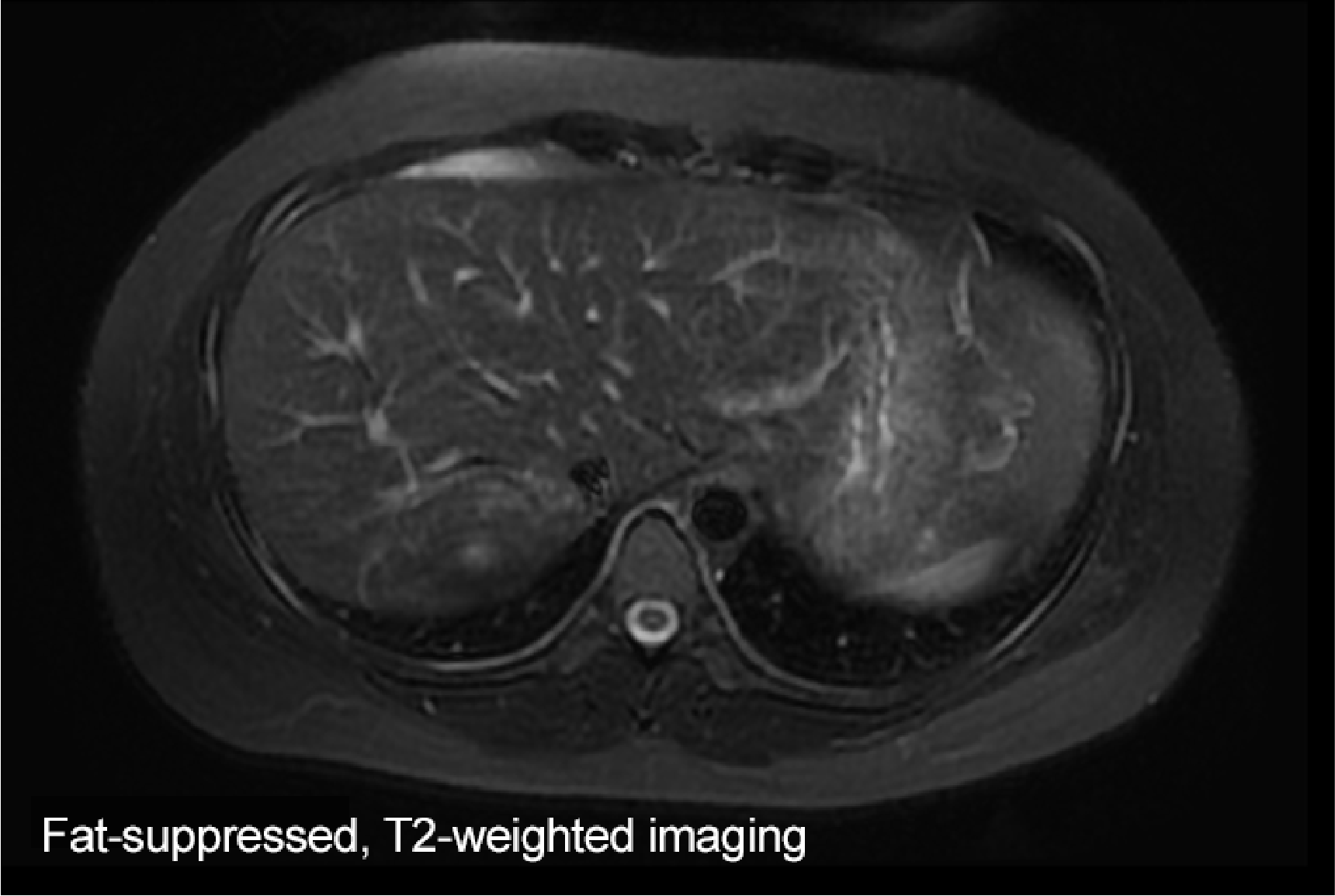 Fig. 1. Initial EOB-MRI image