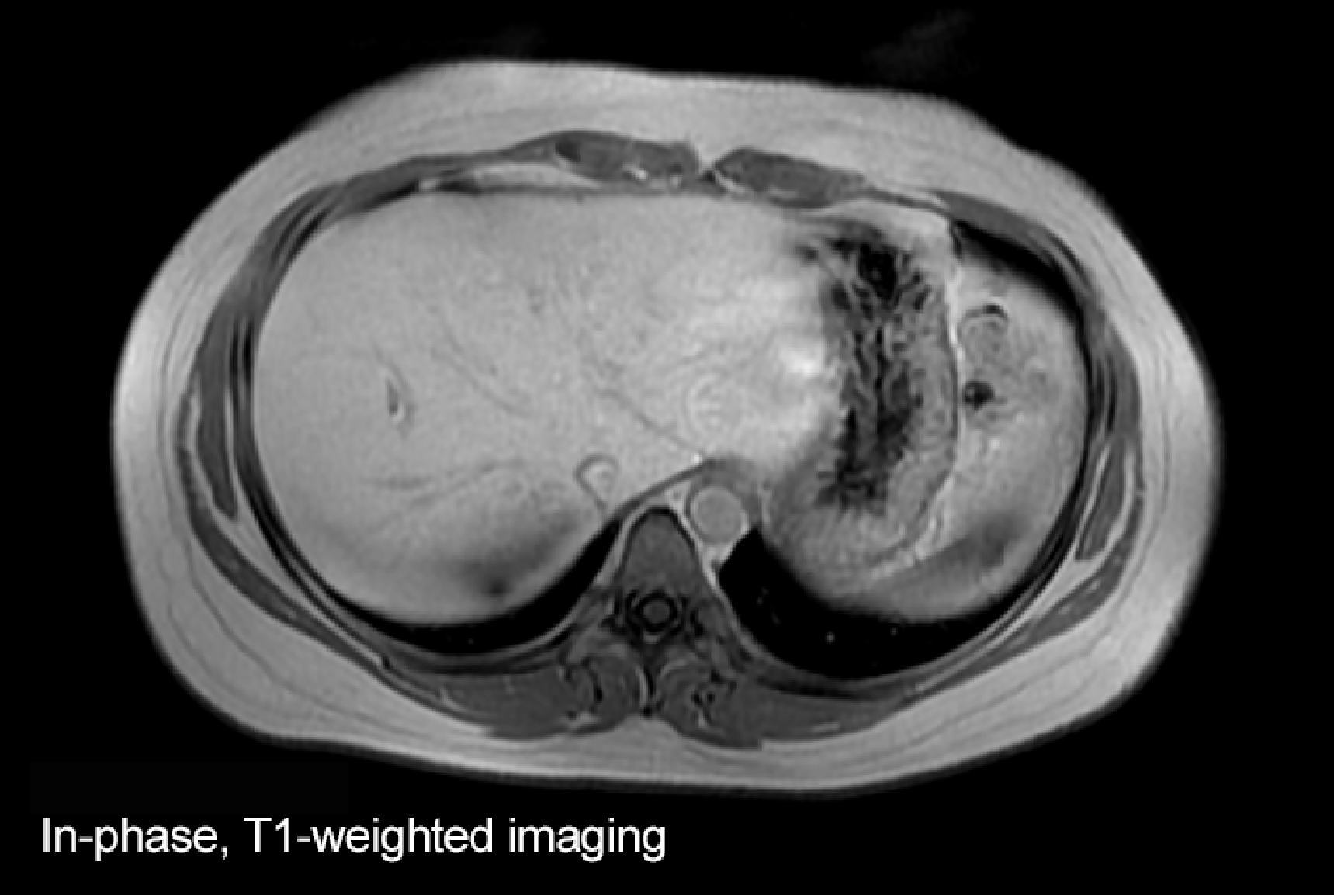 Fig. 1. Initial EOB-MRI image