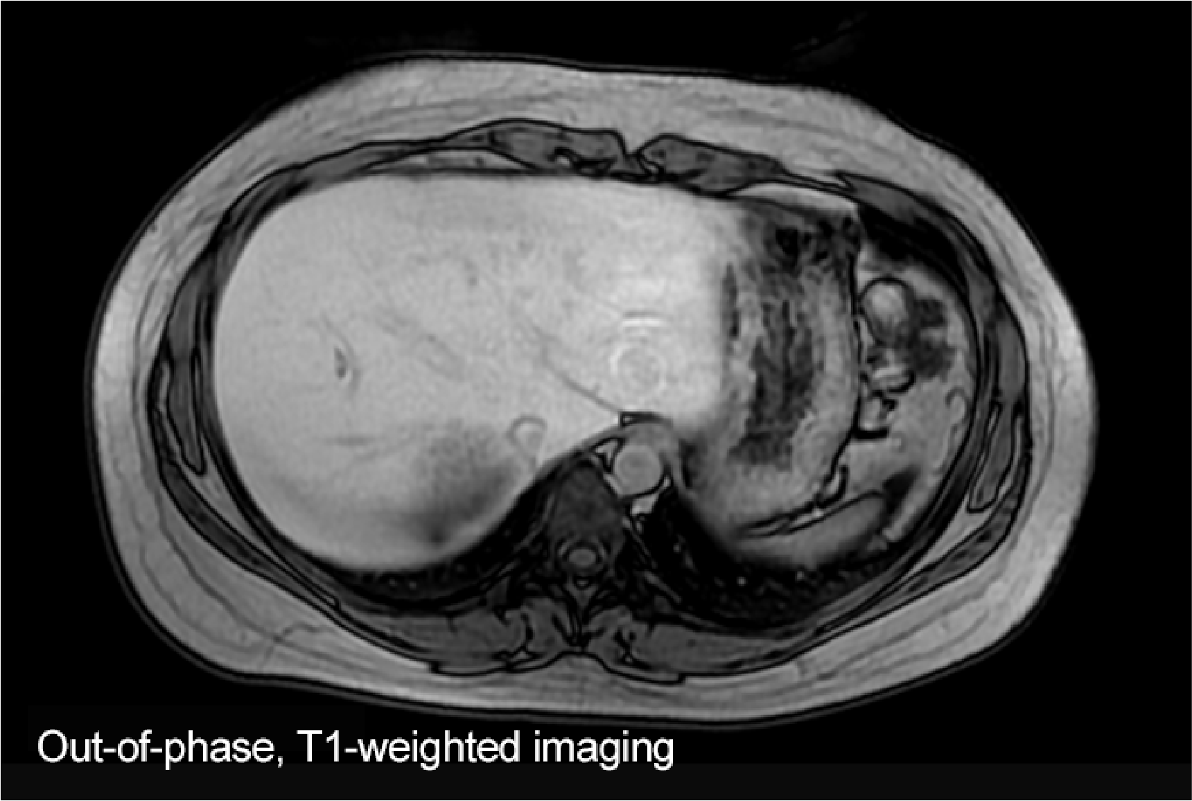 Fig. 1. Initial EOB-MRI image