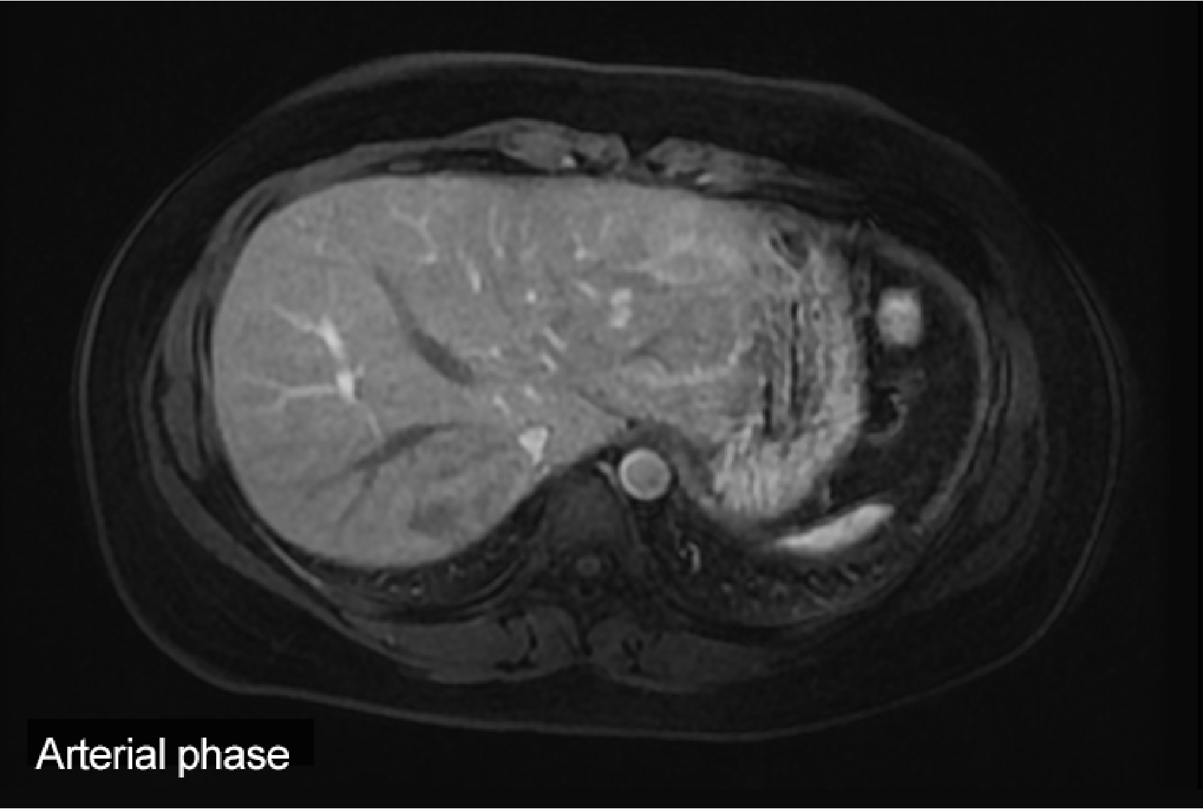 Fig. 1. Initial EOB-MRI image