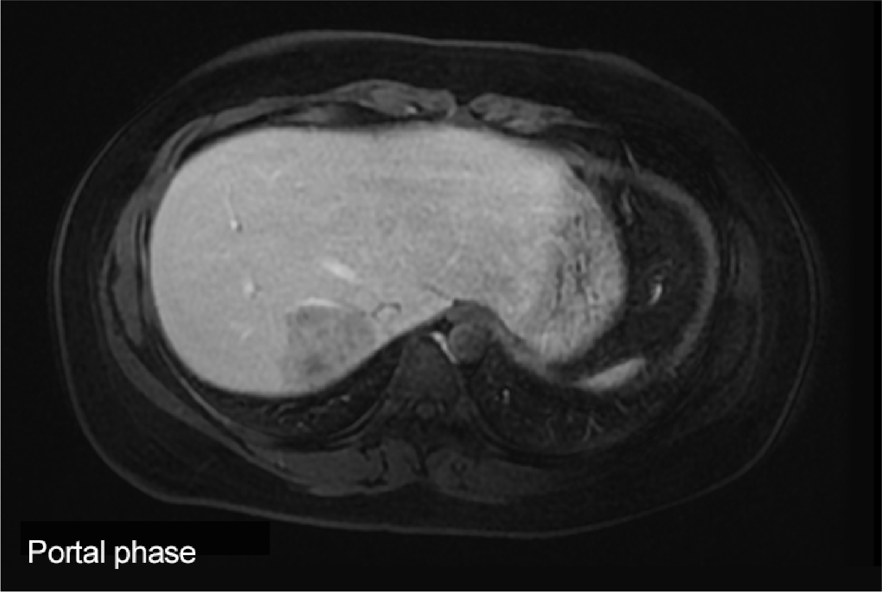 Fig. 1. Initial EOB-MRI image