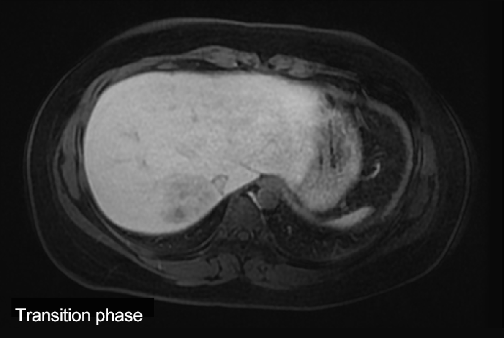 Fig. 1. Initial EOB-MRI image
