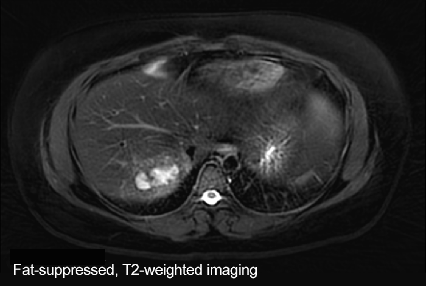 Fig. 2. MRI image, approximately 6 months after initial image