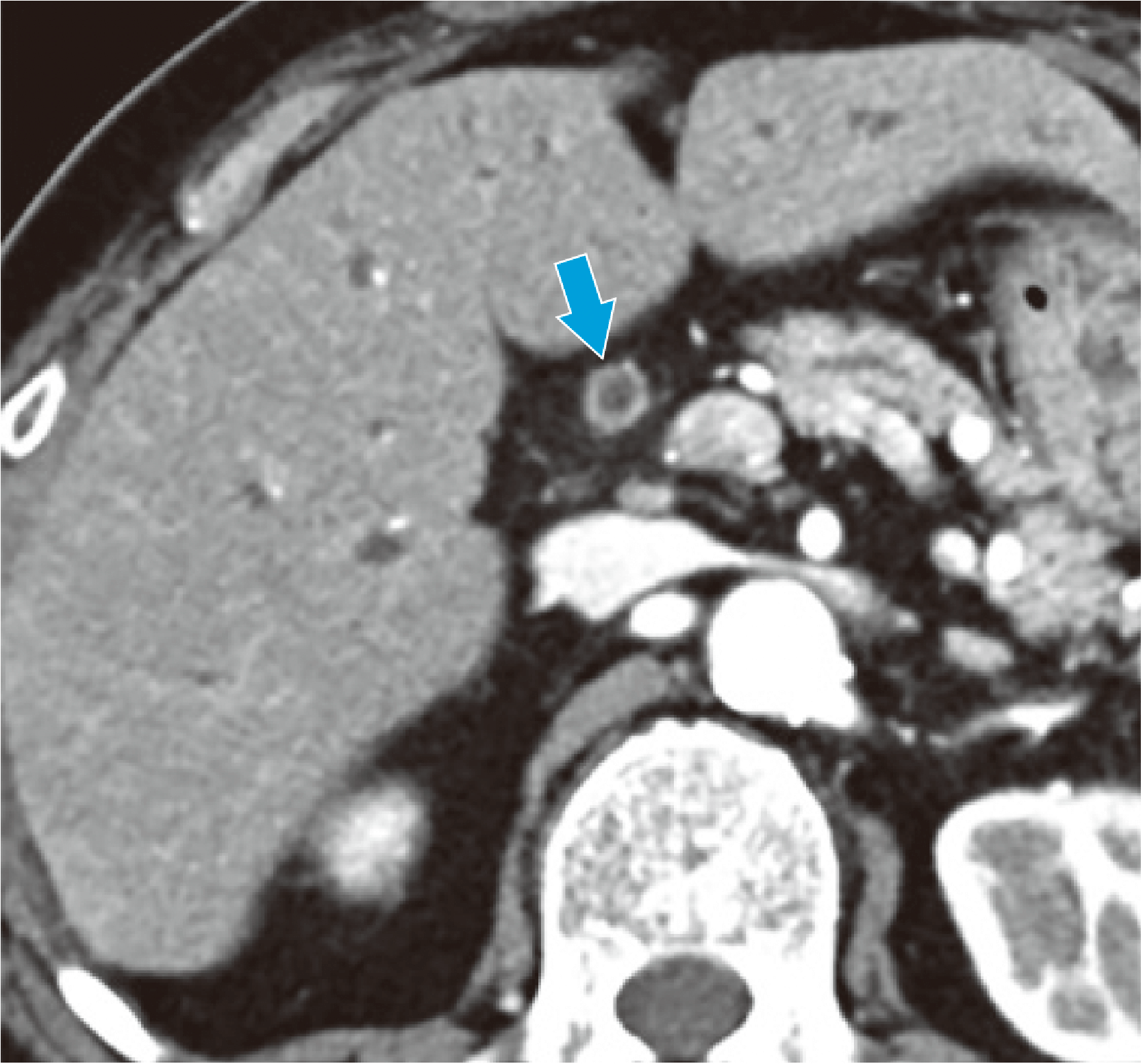 Fig. 1. Horizontal section in the arterial phase