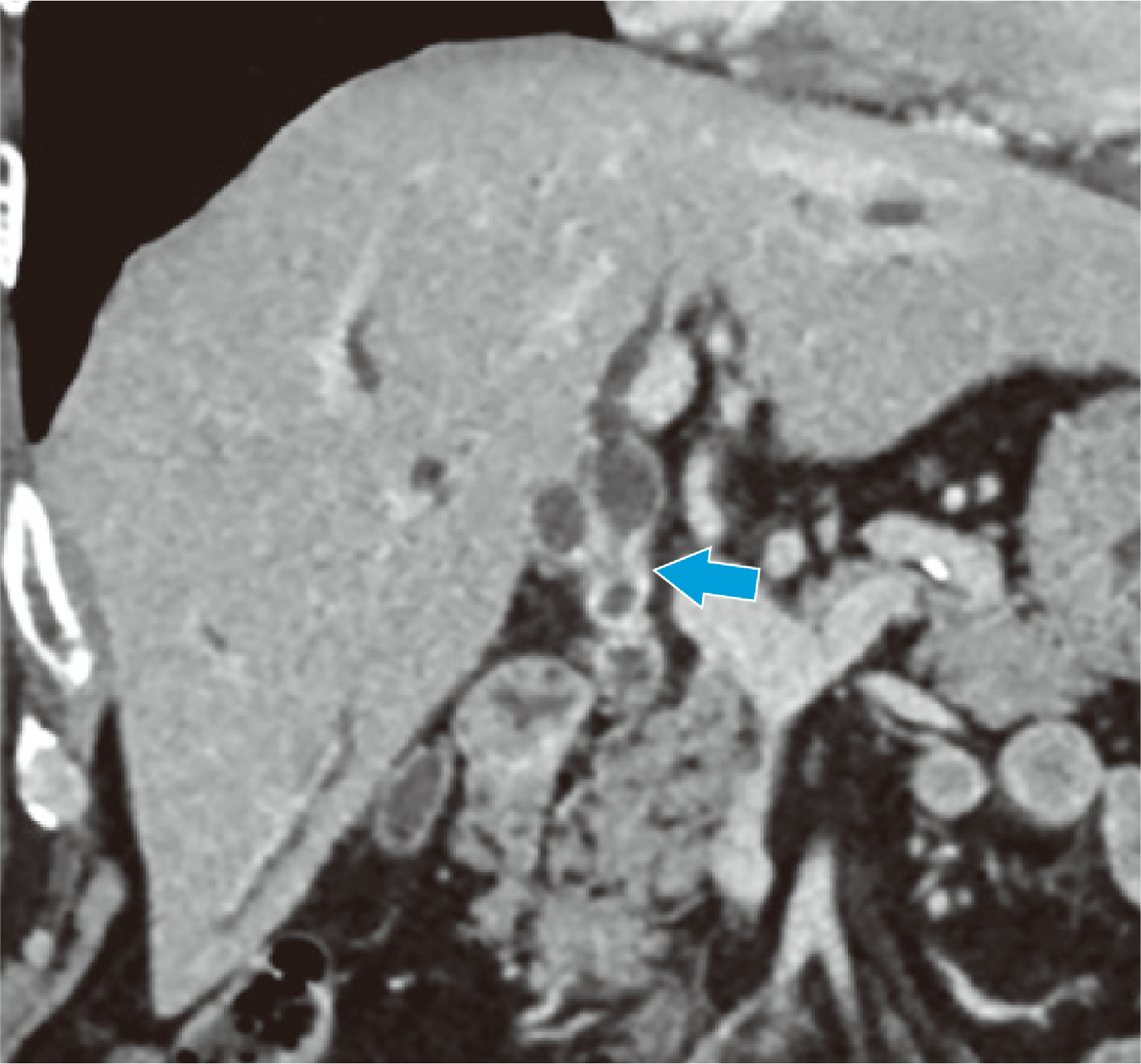 Fig. 3. Coronal section in the equilibrium phase (tumor central region)